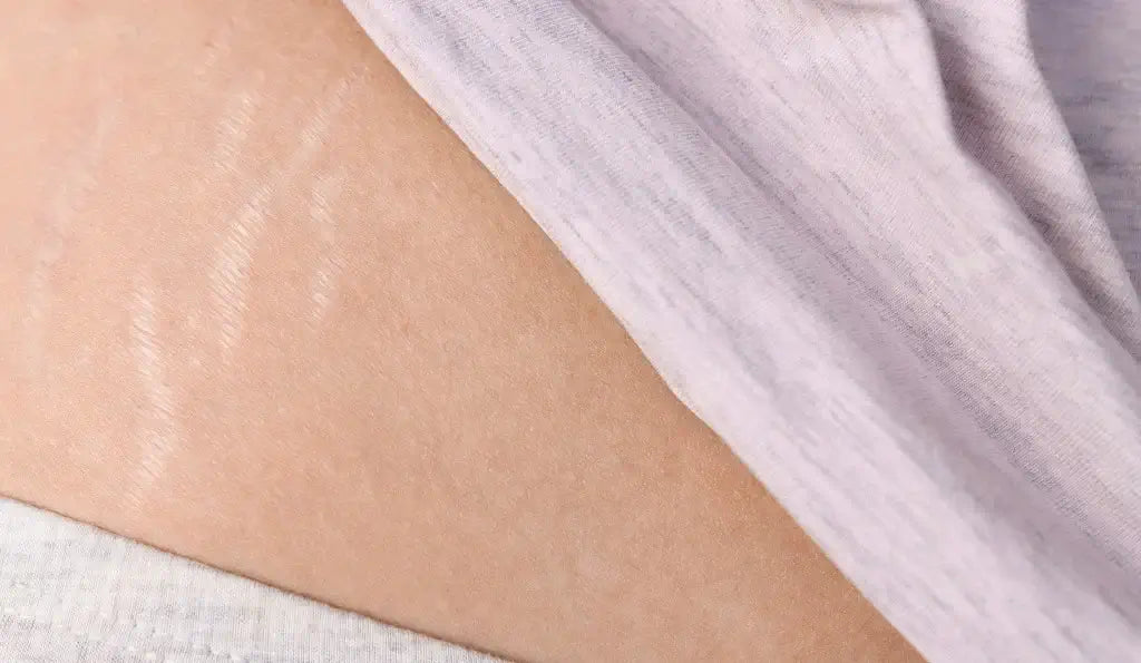Stretch Mark