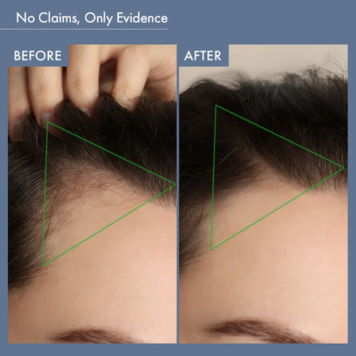 Before & After Image of Using Hair Growth Capsules for Women by ThriveCo