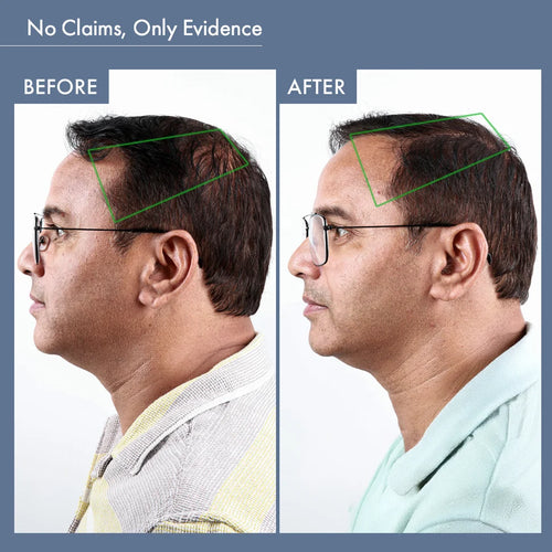 Before & After Image of Using ThriveCo DHT Blocker Supplement for Men