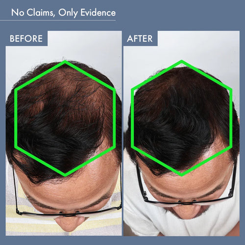 Before & After Image of Using DHT Blocker Supplement for Men by ThriveCo