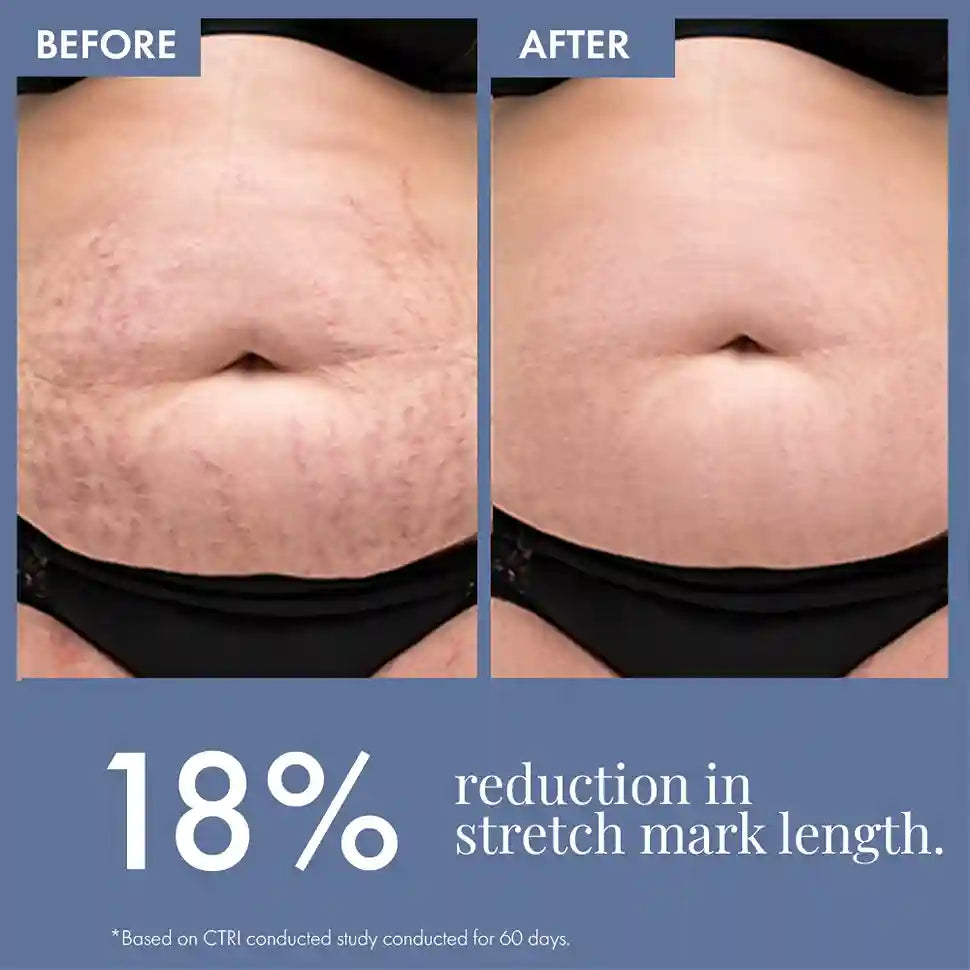 Stretch Marks Expert, Serum Cream 30ml