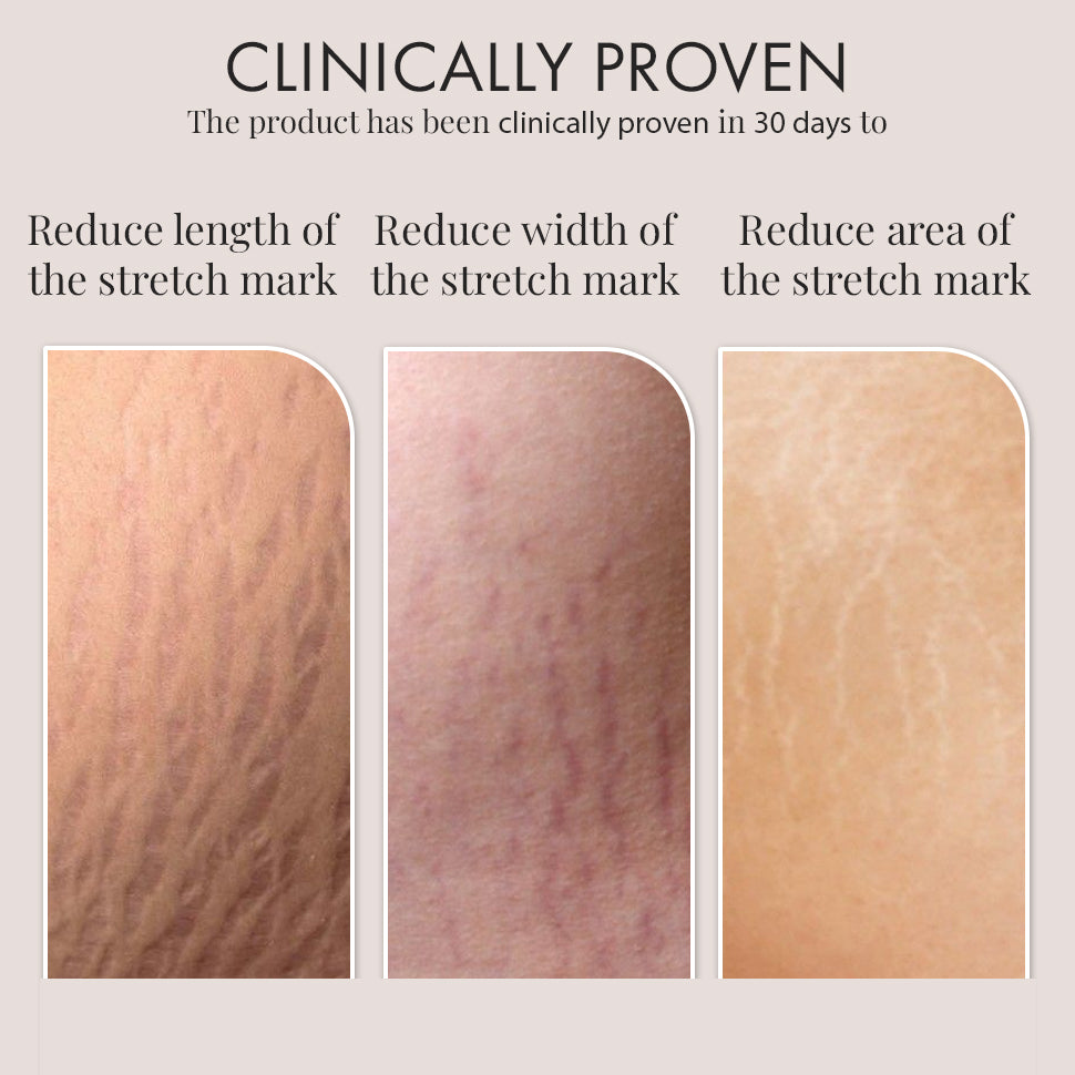 Stretch Marks Trial Kit