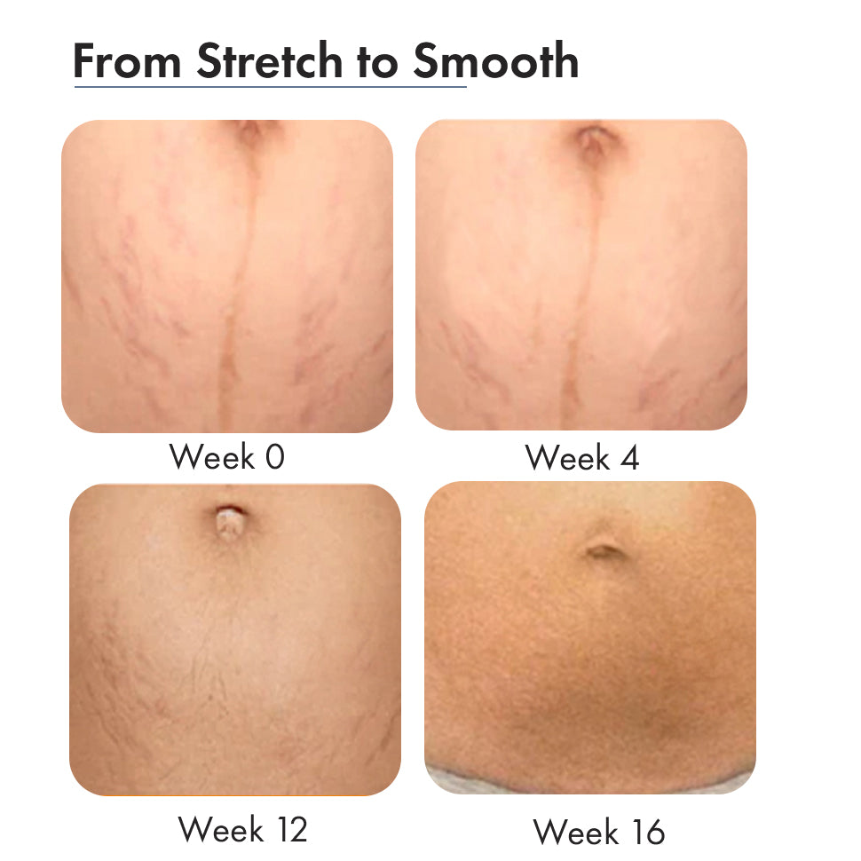 Stretch Marks Trial Kit