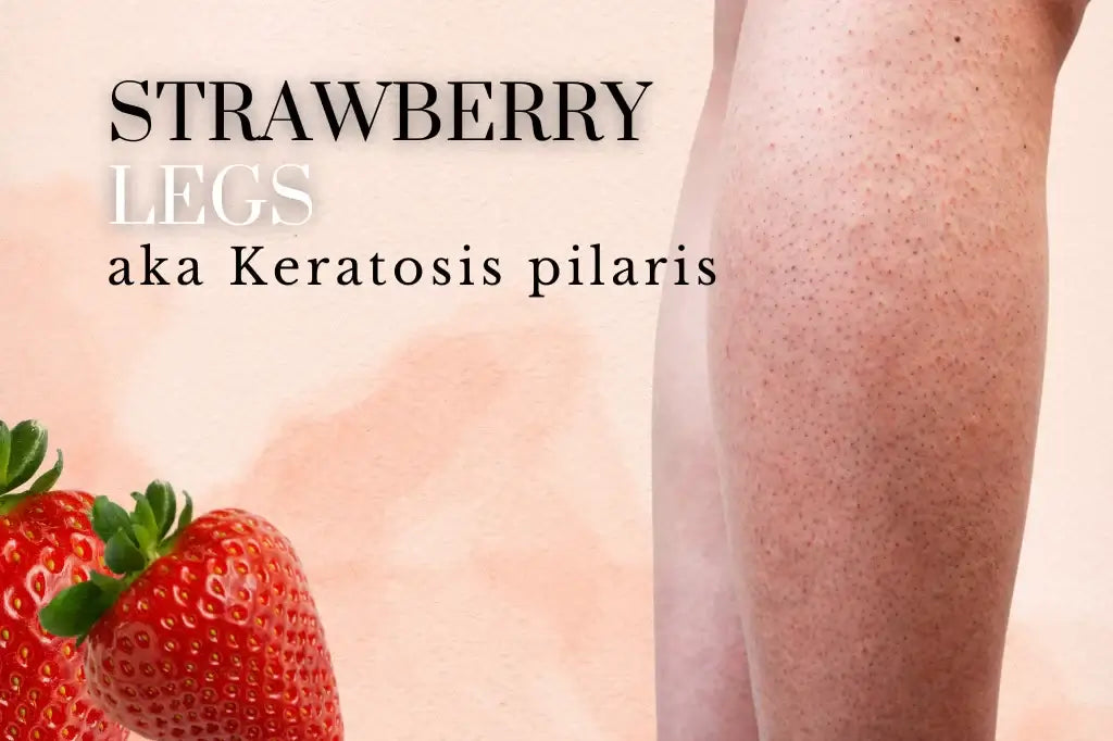 Decoding Strawberry Legs: What, Why And How To Get Rid Of It?