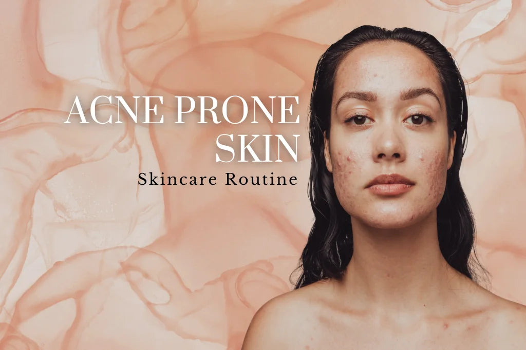 Skincare Routine For Acne-Prone Skin