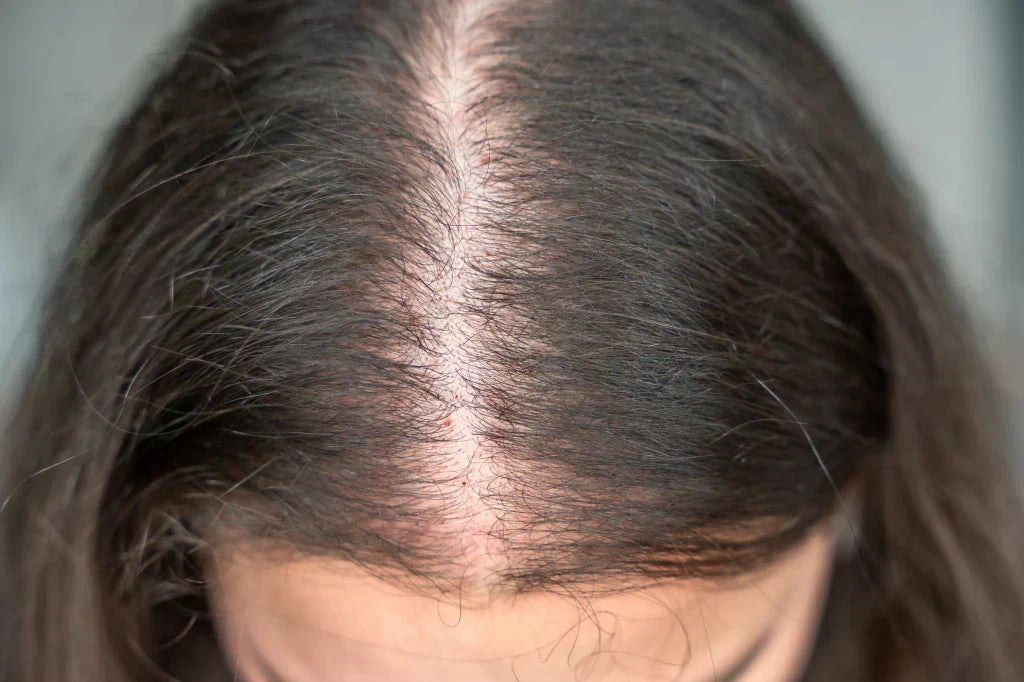 Hair Thinning: Causes, Types, and Treatment