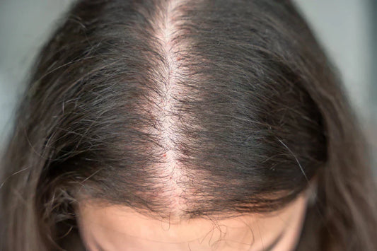 Hair Thinning: Causes, Types, and Treatment