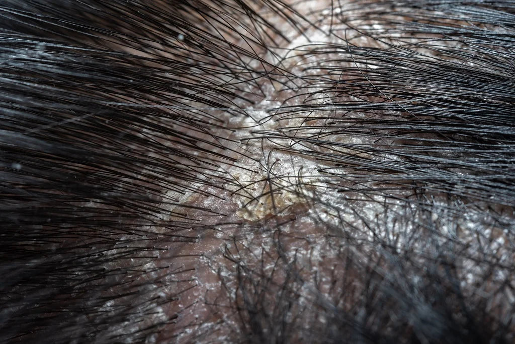 Scalp Peeling