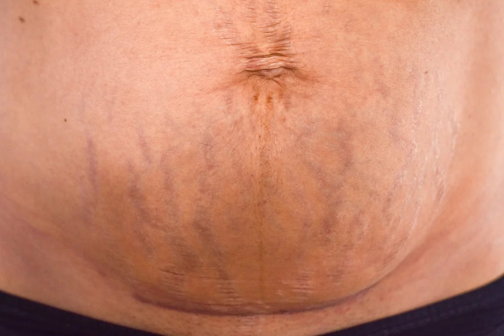 Purple Stretch Marks 