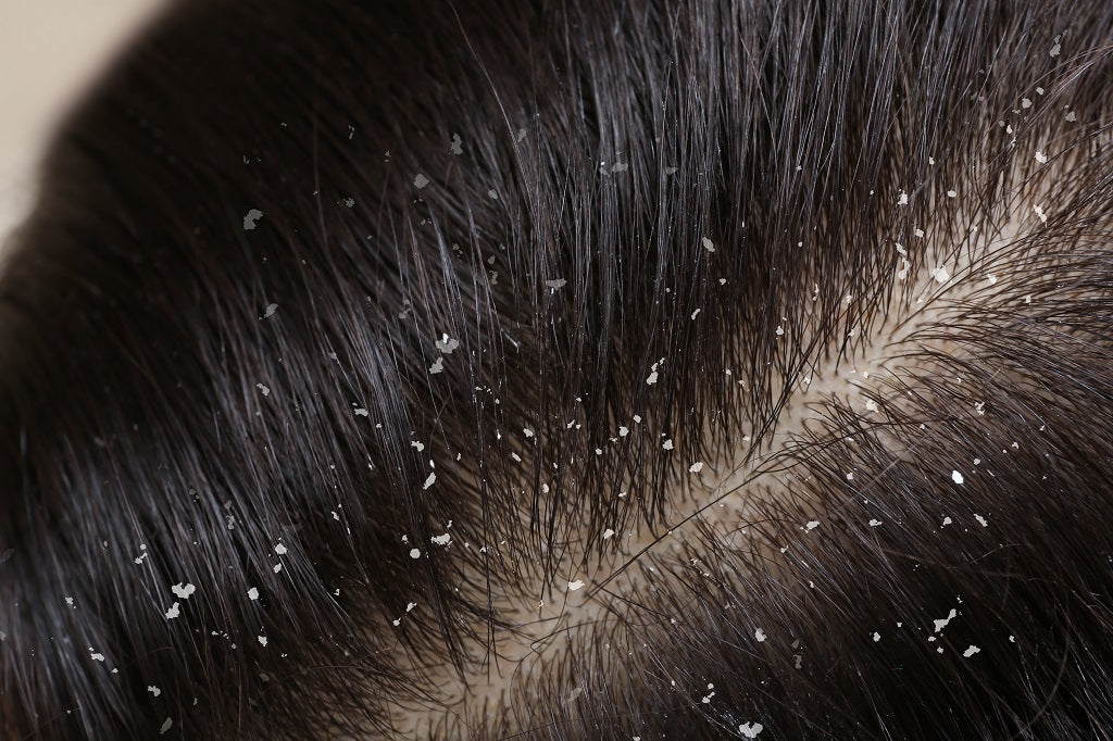 Defeating the dreaded dandruff