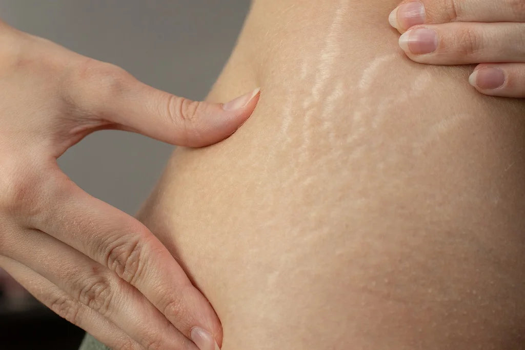 The Ultimate Guide: 7 Effective Ways to Prevent Stretch Marks | ThriveCo