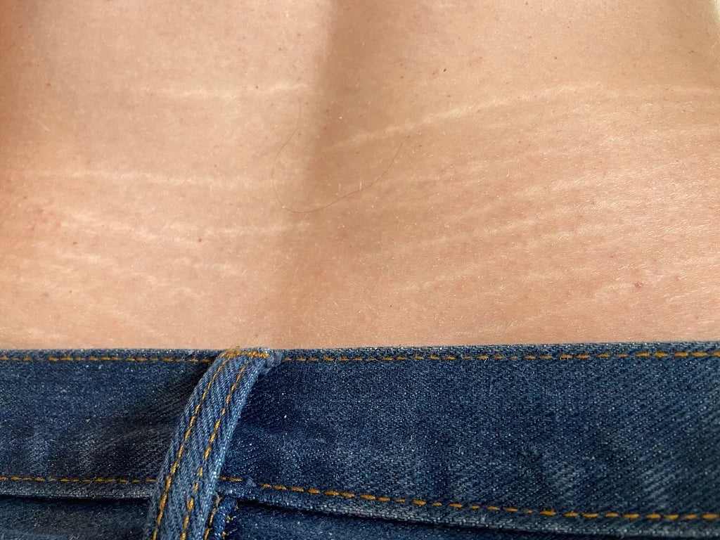 Stretch marks: Why Do They Appear, And How To Get Rid Of Them? | ThriveCo