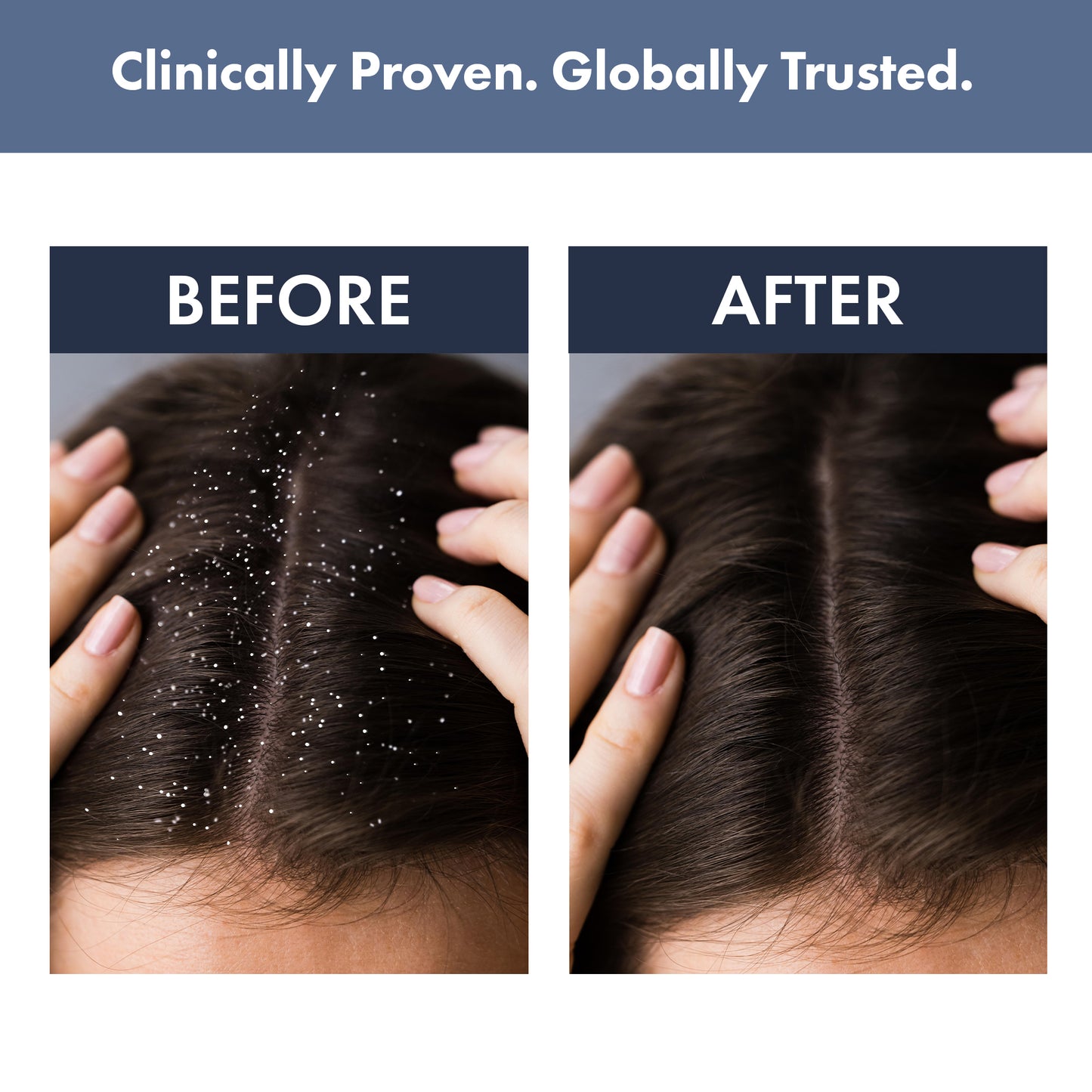 Anti-dandruff kit: Scalp Clear Shampoo + Anti Dandruff Serum