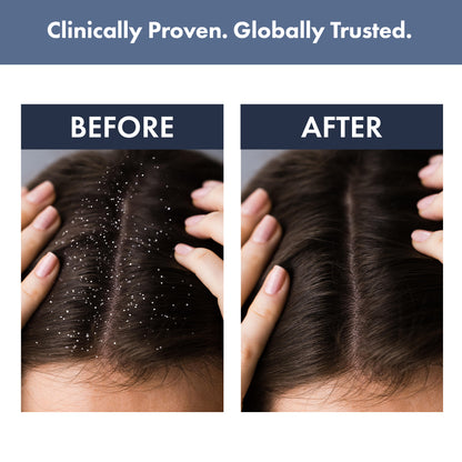 Anti-dandruff kit: Scalp Clear Shampoo + Anti Dandruff Serum