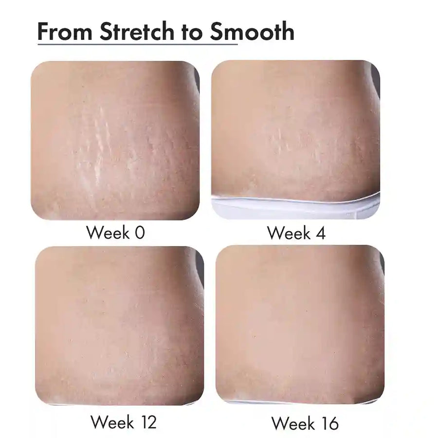 Stretch Marks Expert, Serum Cream 30ml