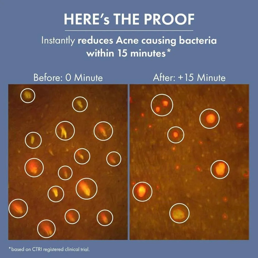 Goodbye Acne Cleanser & Acne Serum