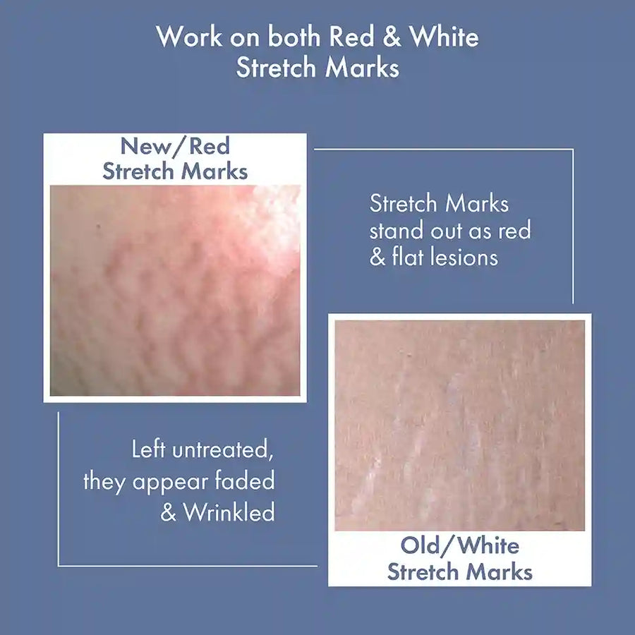 Stretch Marks Expert, Serum Cream 30ml