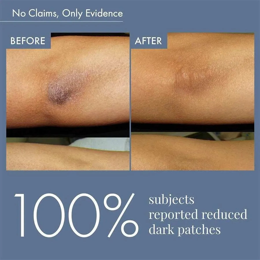 Dark Patches Corrector for Men & Women, 100ml