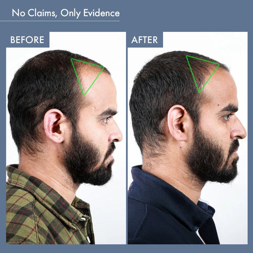 Before & After Image of Using ThriveCo Hair Growth Supplement for Men