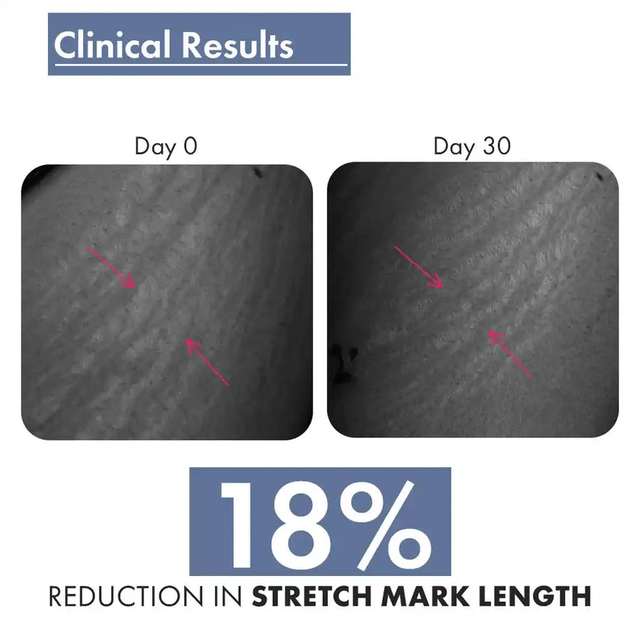 Stretch Marks Expert, Serum Cream 30ml