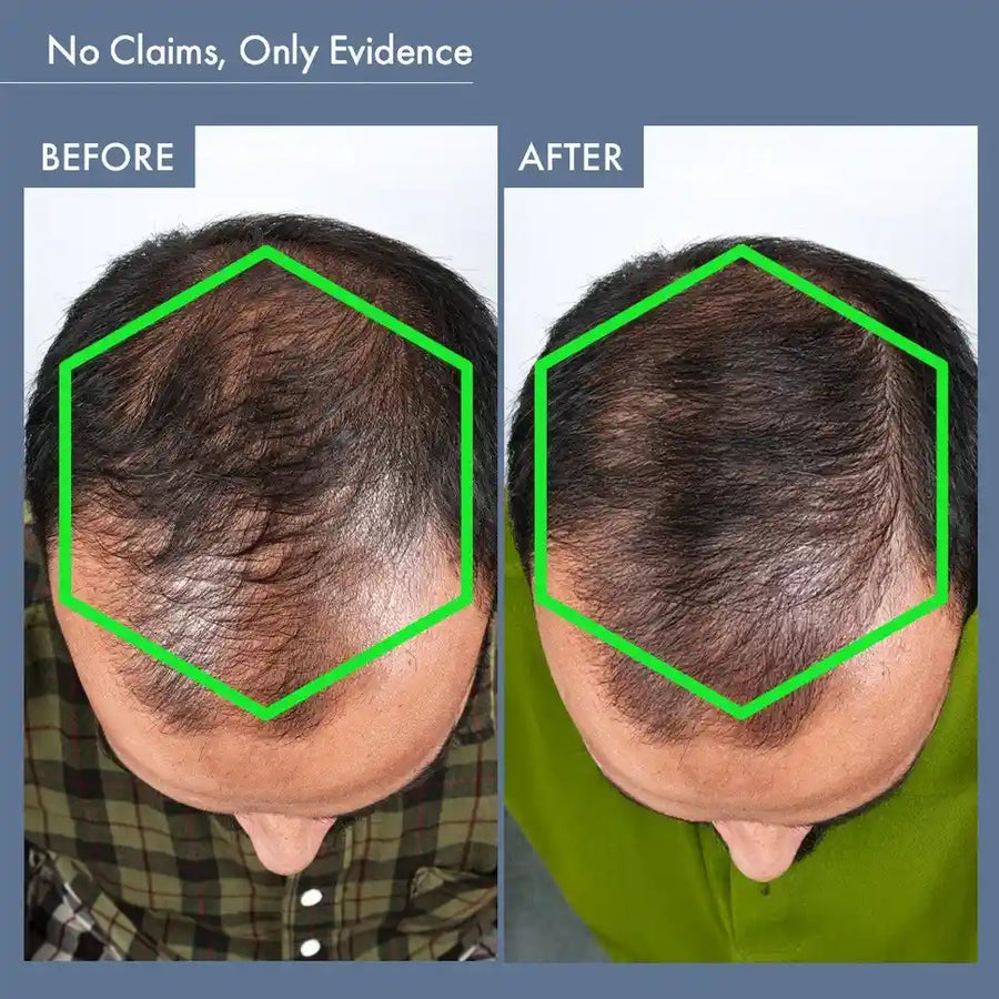 Men’s Hair Growth Solution with DHT Blocker