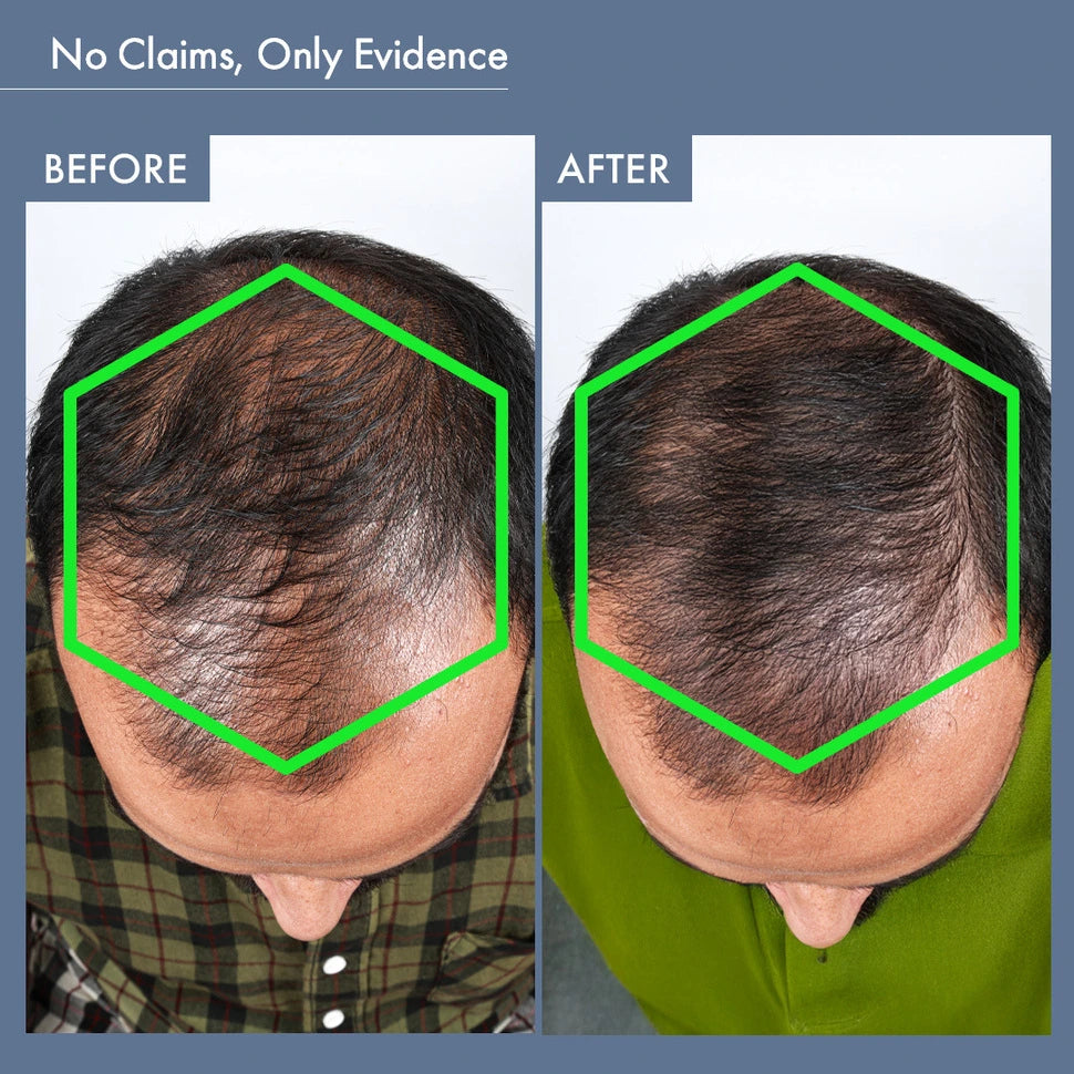 Before & After Image of Using Hair Growth Capsules for Men by ThriveCo