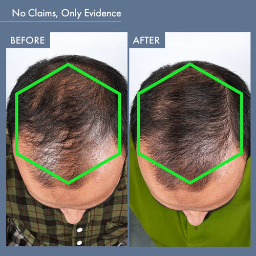 Before & After Image of Using Hair Growth Capsules for Men by ThriveCo