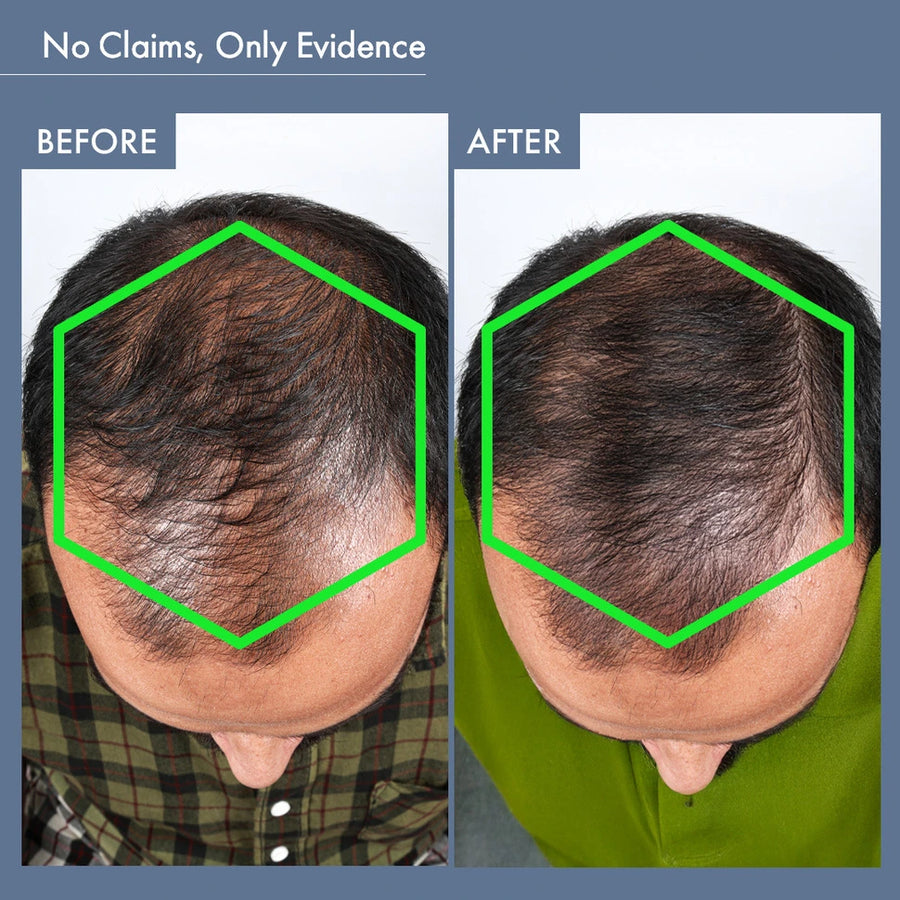 Before & After Image of Using Hair Growth Capsules for Men by ThriveCo