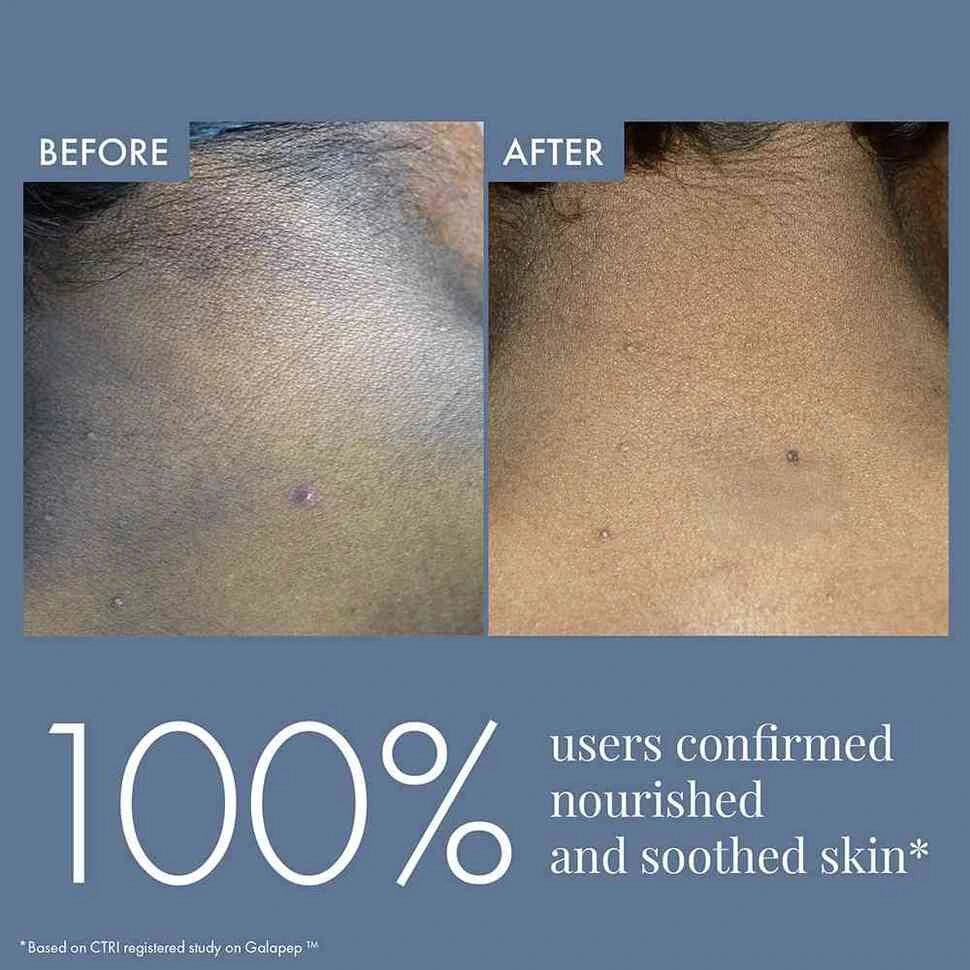 Dark Patches Corrector for Men & Women, 100ml