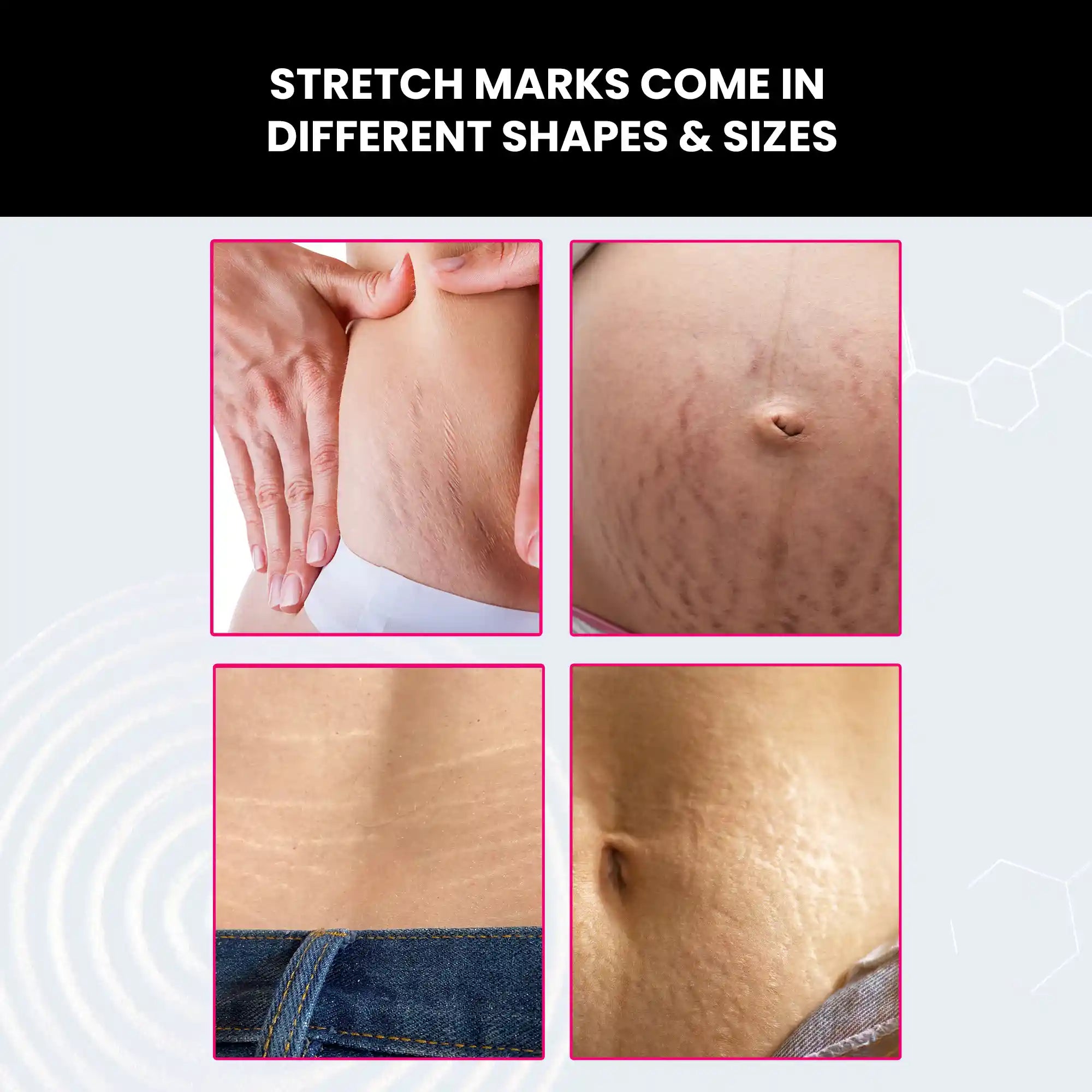 ThriveCo Stretch Marks Expert, Serum Cream for Women, 30ml