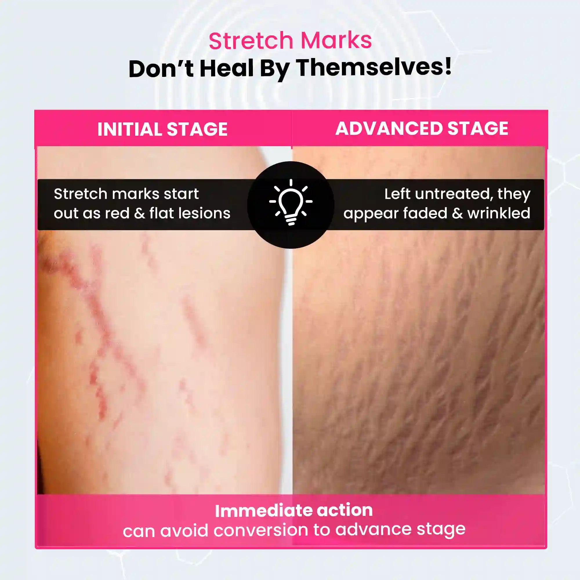 Sratch Marks Best Stretch Marks Serum Cream for Women, See Visible Results in 28 Days