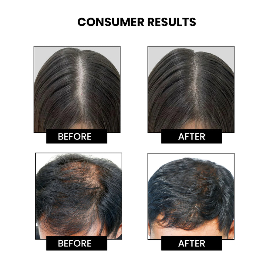 Dandruff Treatment Trial kit