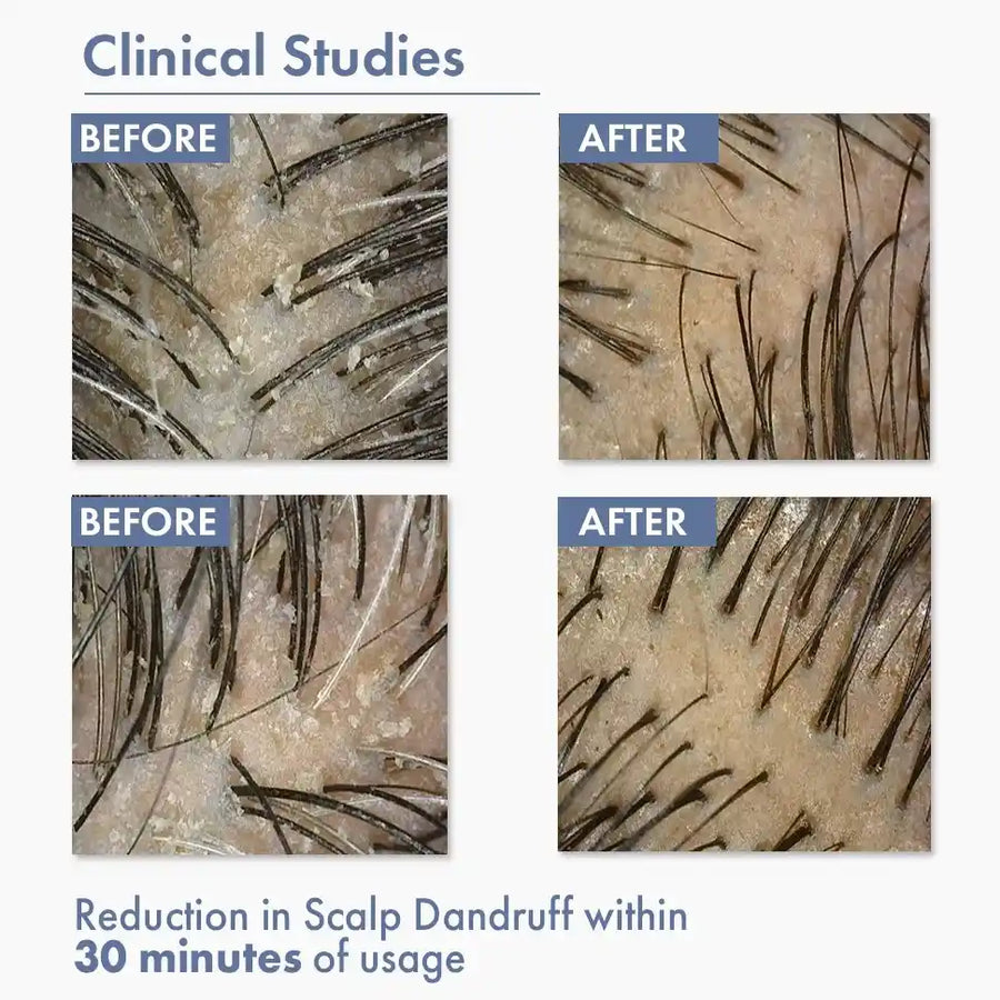 Anti Dandruff Serum, 10ml