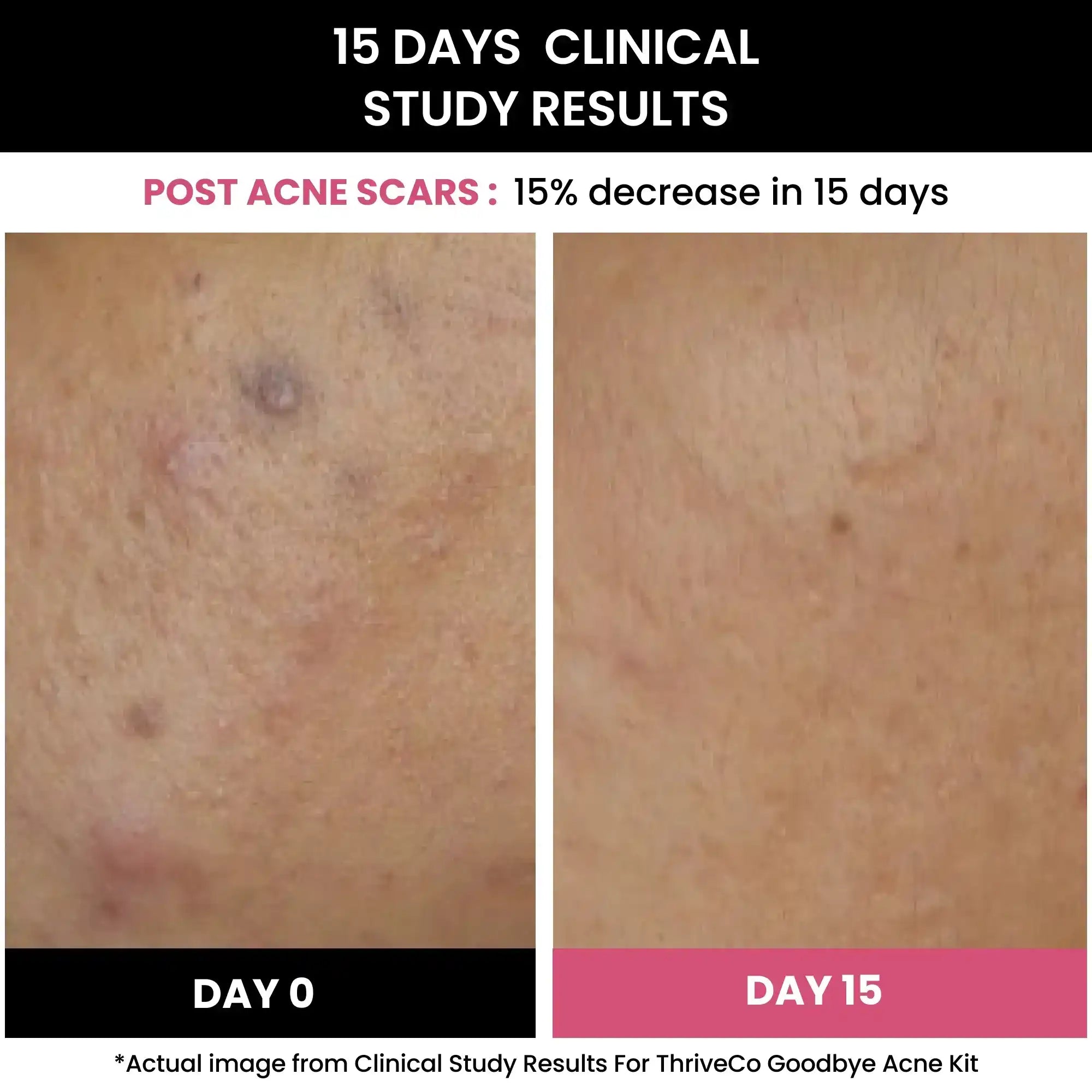 Before and after results of ThriveCo Goodbye Acne Kit for women