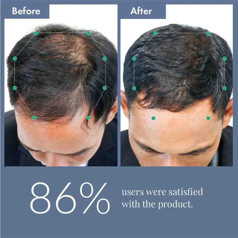 Before-and-after images of a man's scalp show improved hair density, reflecting 86% user satisfaction with the product.