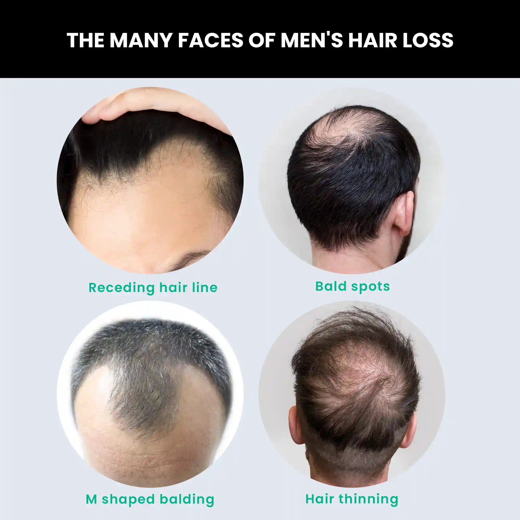 mens hair growth serum for bald spots hair thinning m shaped balding and receding hair line