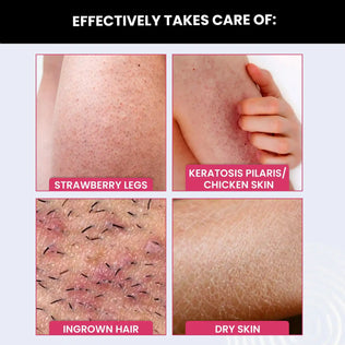 remove keratosis pilaris chicken skin strawberry legs ingrown hair dry skin with bumps eraser