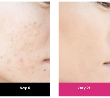results after using niacinamide face serum for 21 days