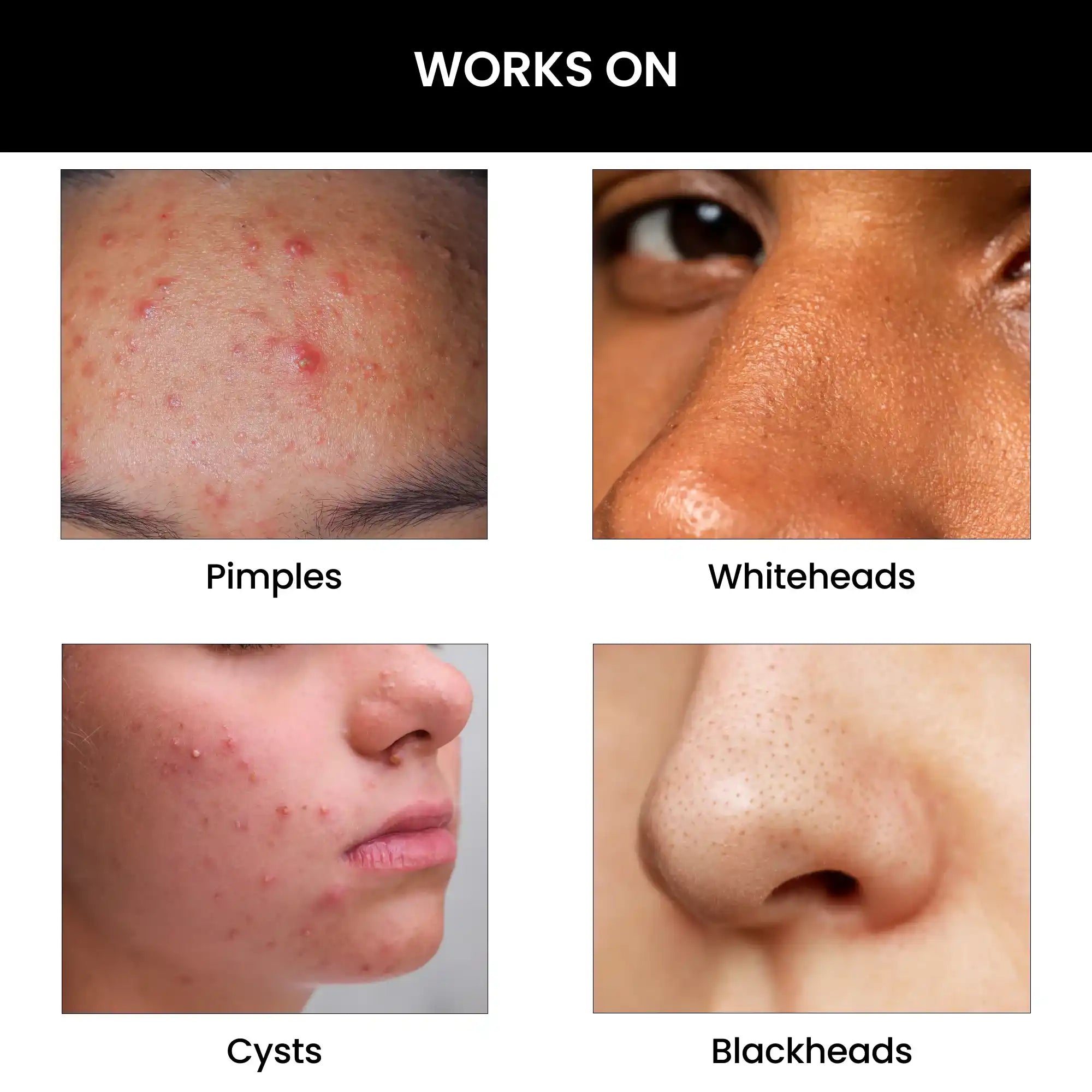 Say Goodbye To Big Blackheads With These Expert Tips - d45rpok