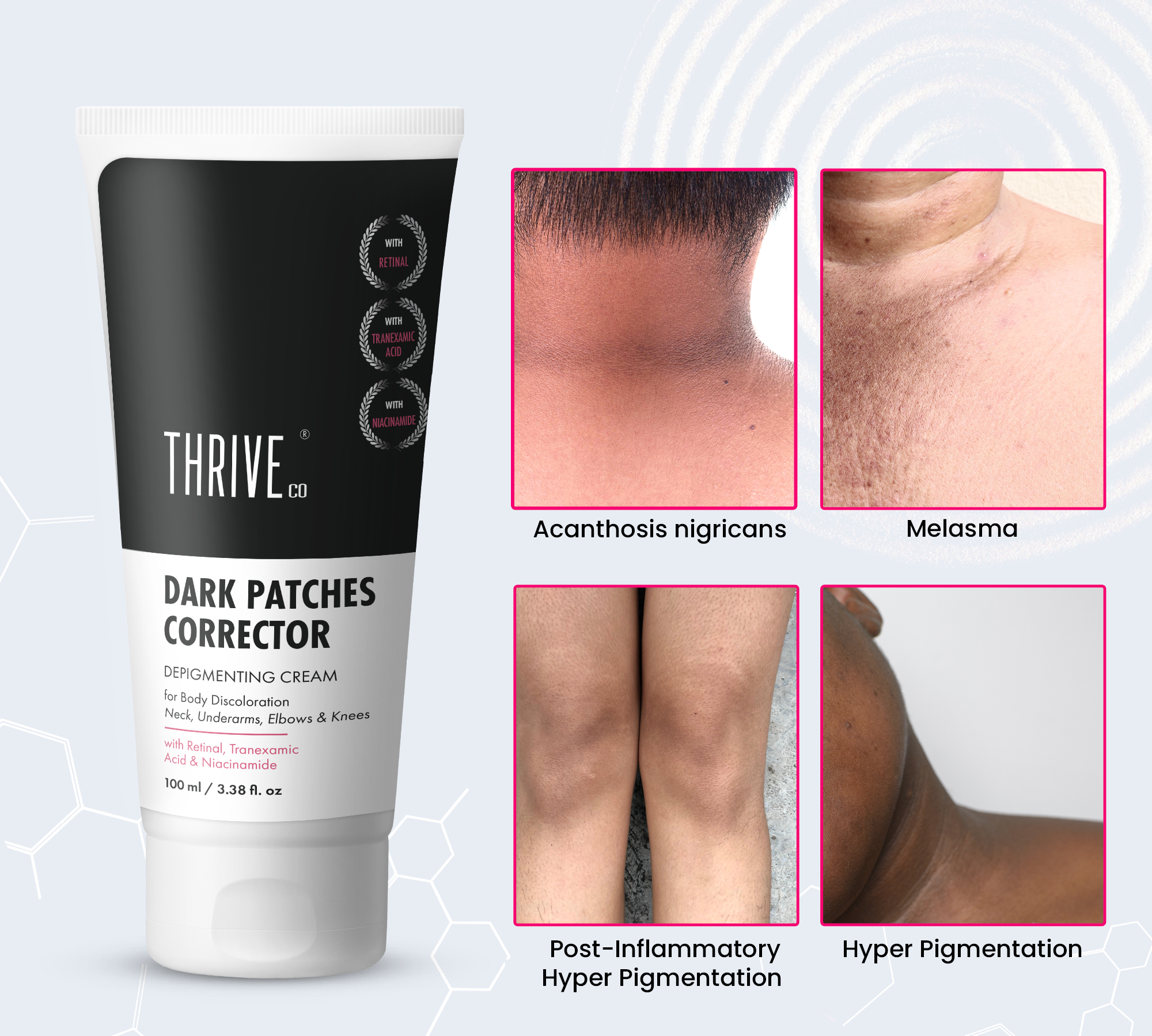 dark patches removal cream