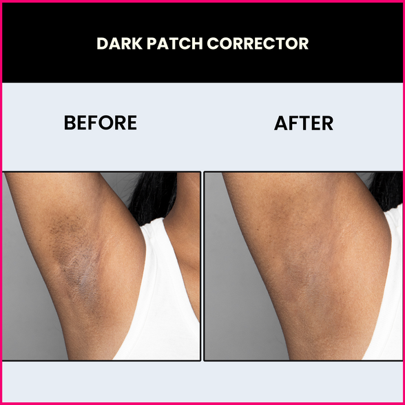 dark spot removal cream for underarms