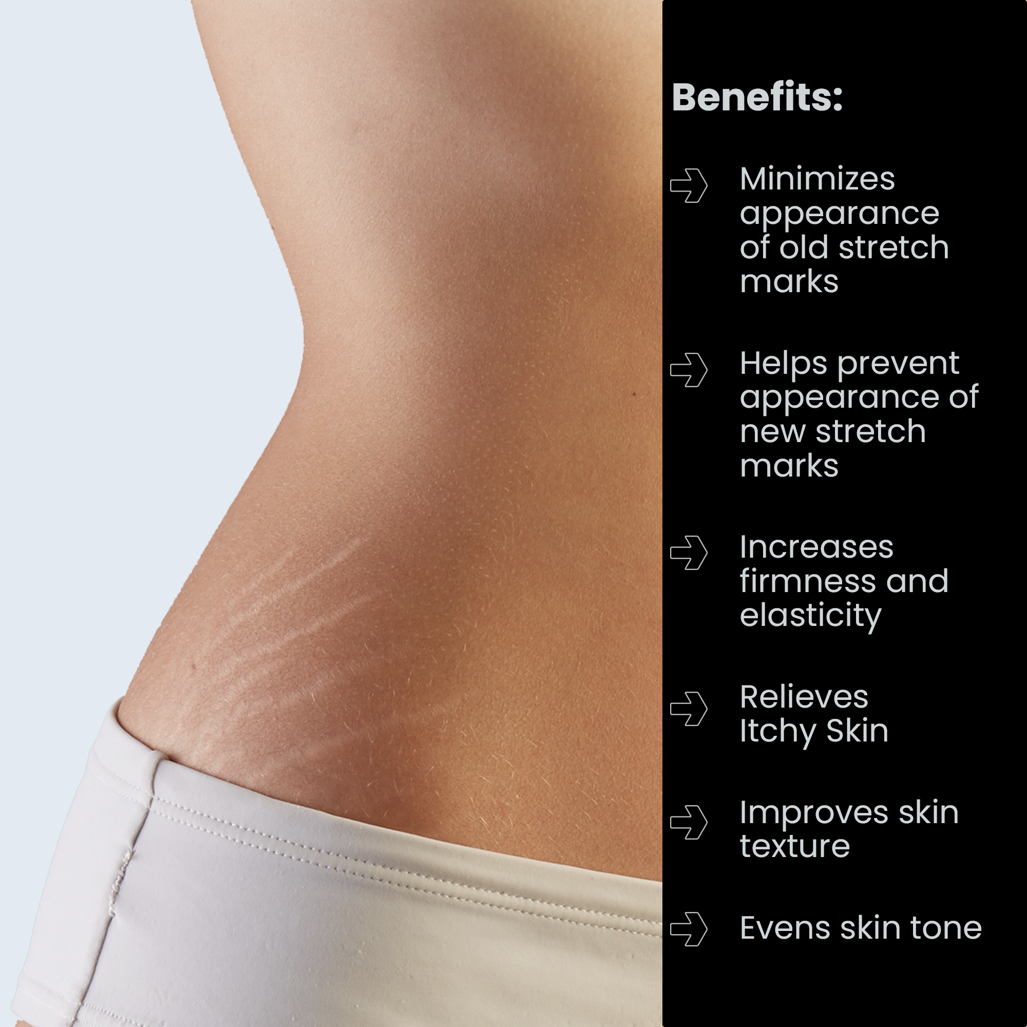 how to remove stretch marks