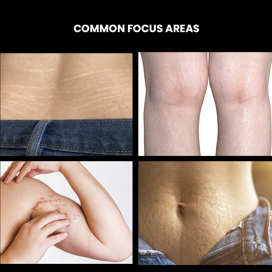 Buy ThriveCo Stretch Marks Expert Stretch Marks Removal Cream