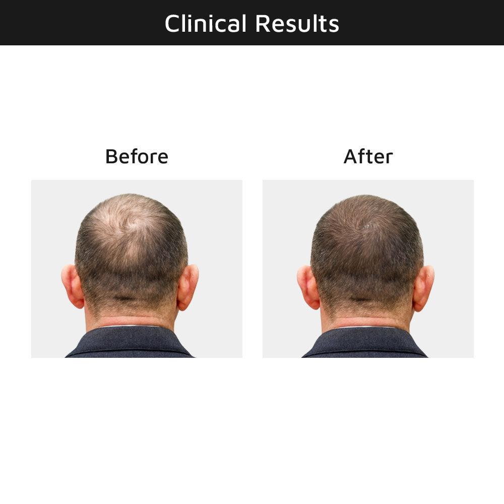 Hair Growth Serum Before & After