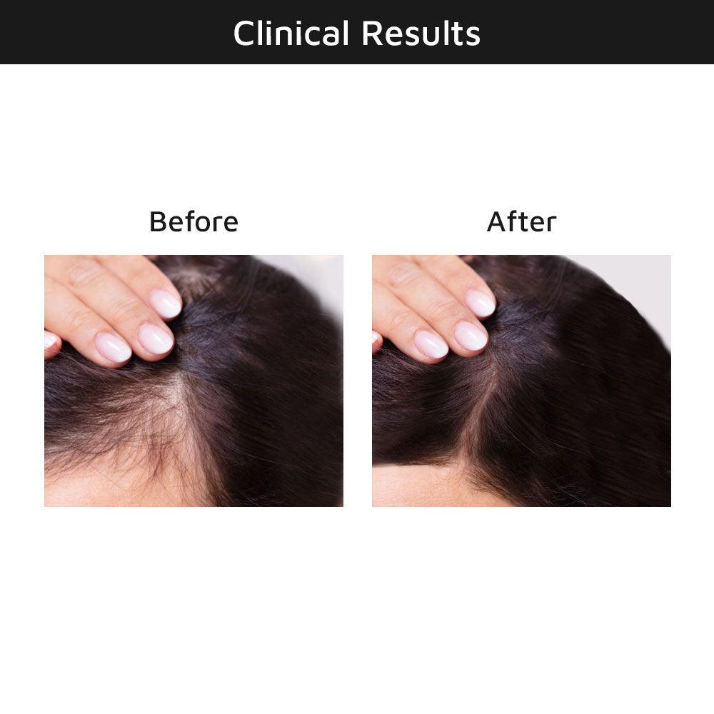 Hair Growth Serum Clinical Results