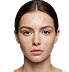 Acne Marks