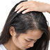 Dandruff